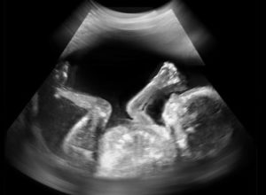 Fetus image