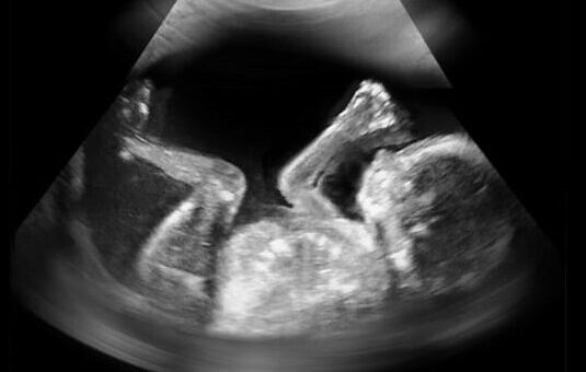 Fetus image